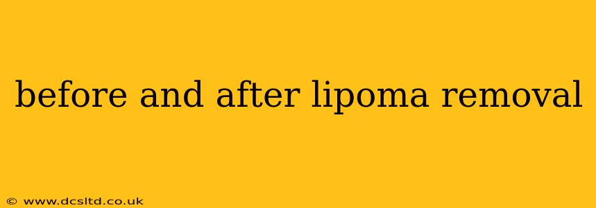 before and after lipoma removal
