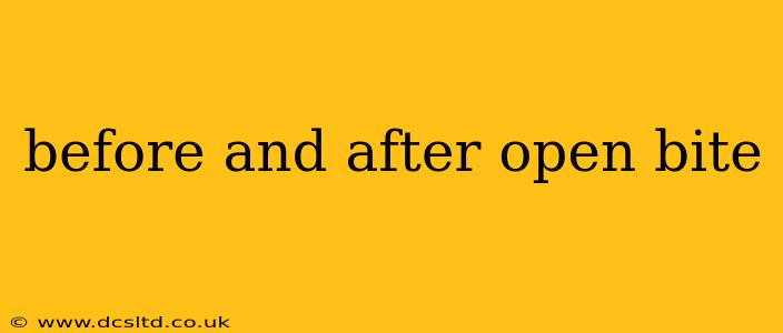 before and after open bite