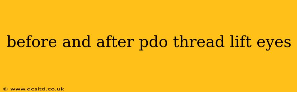 before and after pdo thread lift eyes
