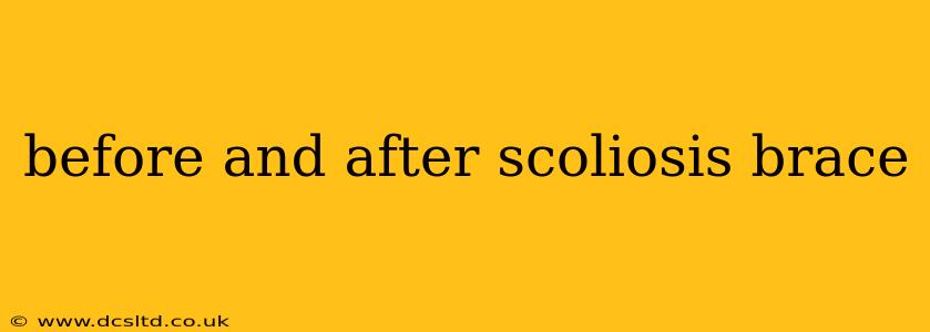 before and after scoliosis brace