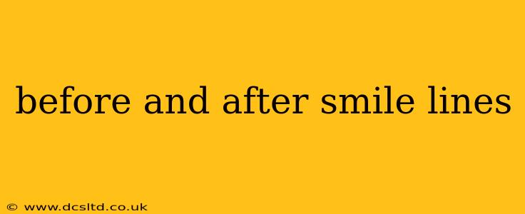 before and after smile lines