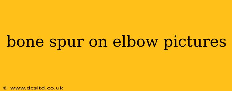 bone spur on elbow pictures