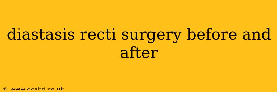 diastasis recti surgery before and after