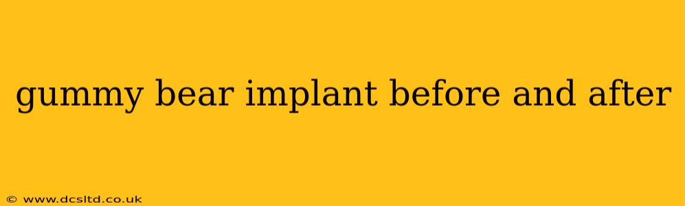 gummy bear implant before and after