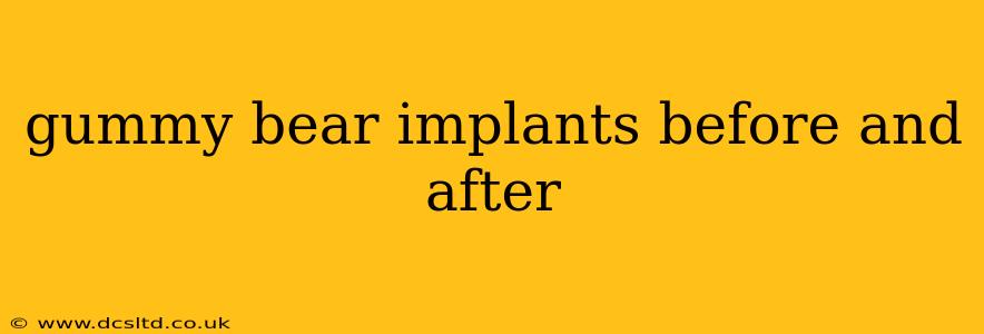 gummy bear implants before and after