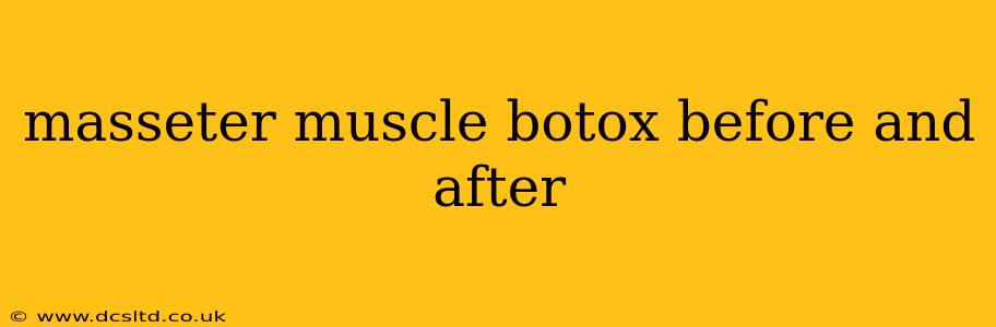 masseter muscle botox before and after