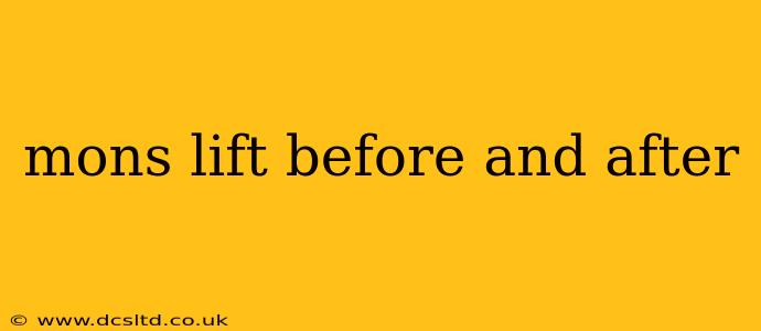 mons lift before and after