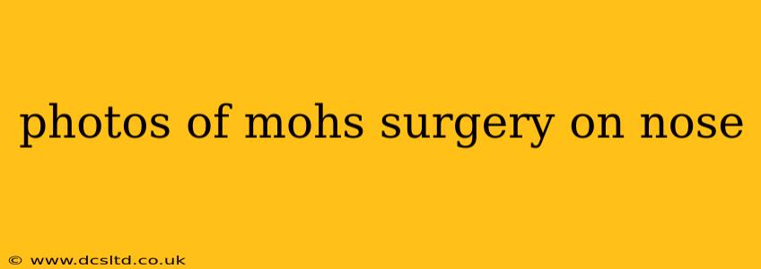 photos of mohs surgery on nose