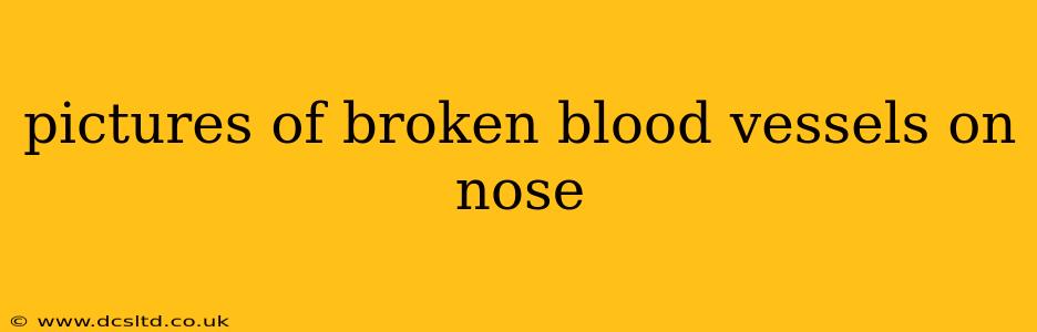 pictures of broken blood vessels on nose