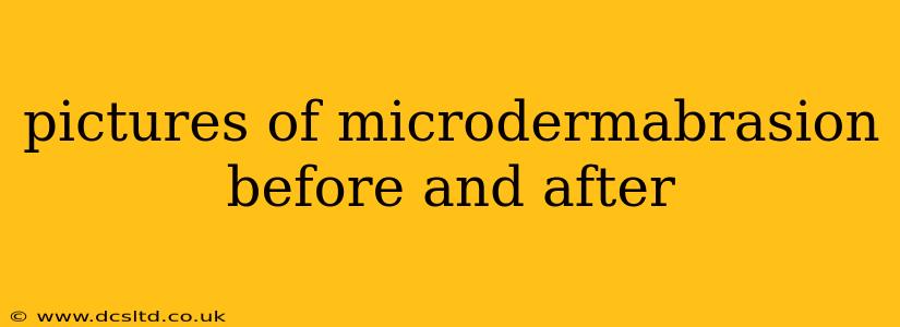 pictures of microdermabrasion before and after