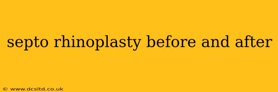 septo rhinoplasty before and after