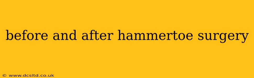 before and after hammertoe surgery
